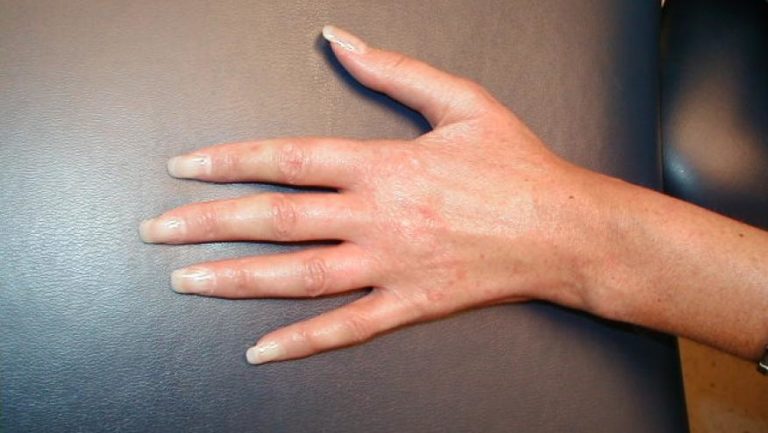 How Are Lupus And Scleroderma Connected?