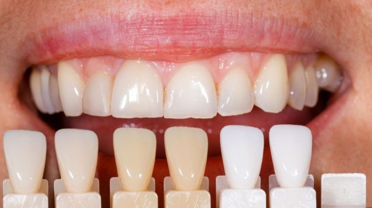 Read to Know A Few Do’s and Don’ts for Teeth Whitening