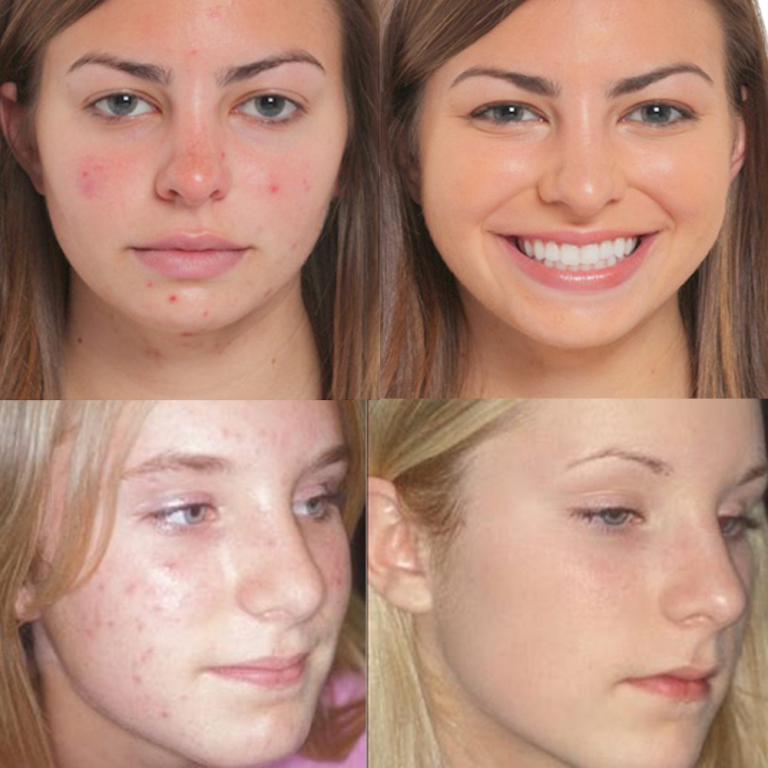 What is Fotona and What Can It Do for You?