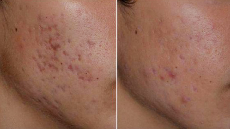 What Makes Rejuran S Different From Other Acne Scar Treatments?