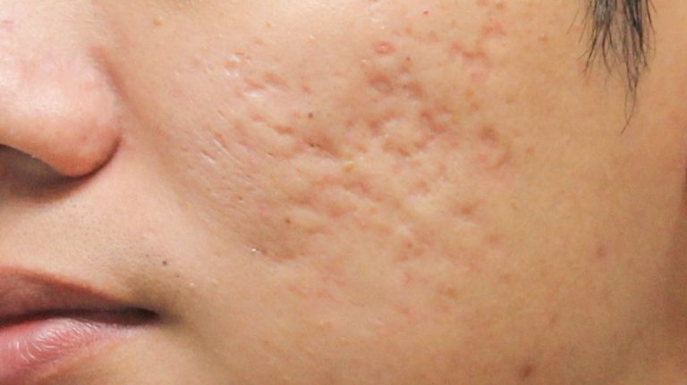 What are the Types of Acne Scars and the Best Treatments?