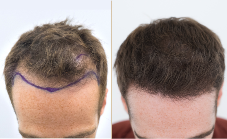 What You Should Know About Hair Transplant in Malaysia