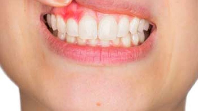 Gum or Periodontal Disease Exposed: Causes and Cures 