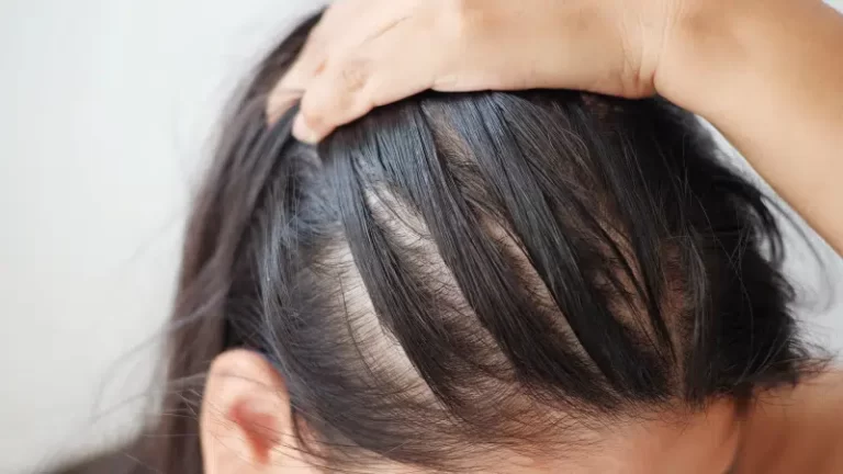 Fotona Hair Growth Laser: Revolutionizing Scalp Treatments
