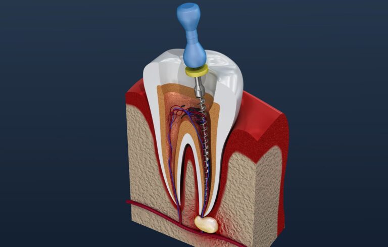 Root Canal Treatment: Your Journey to Oral Rehabilitation