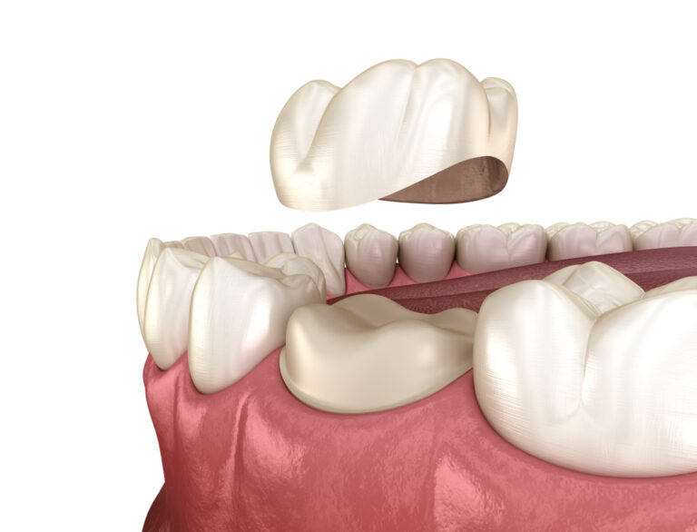 CEREC Crowns: A Same-Day Smile Solution with Your Dentist