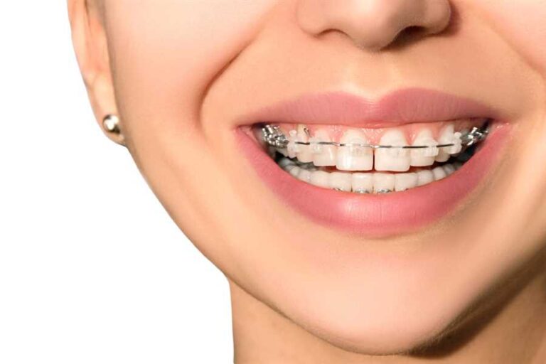 What Are The Alternatives To Fixing Gaps In Your Teeth Without Braces?
