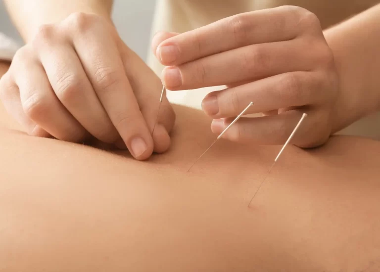 What to Expect During Your First Acupuncture Session