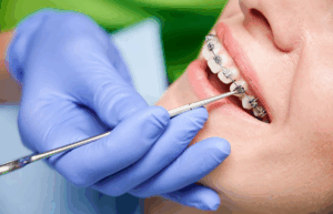 An Overview of How Teeth Braces Improve Dental Health