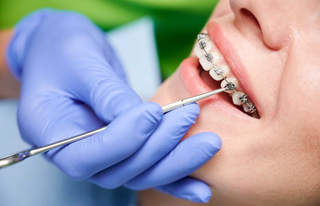 An Overview of How Teeth Braces Improve Dental Health