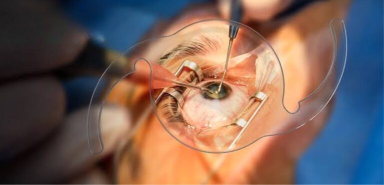 Common Side Effects After Cataract Surgery and How to Handle Them