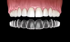 Invisalign Treatment process – The 4 stages