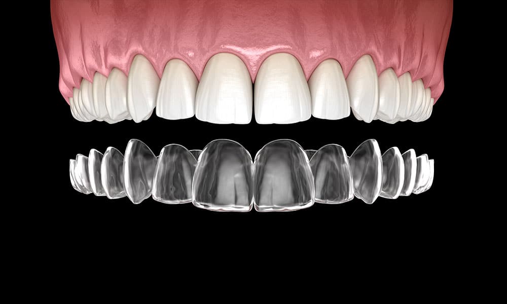 Invisalign Treatment process – The 4 stages